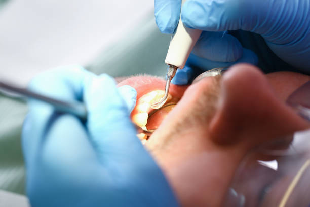 Best Chipped Tooth Repair Near Me  in Plain City, OH